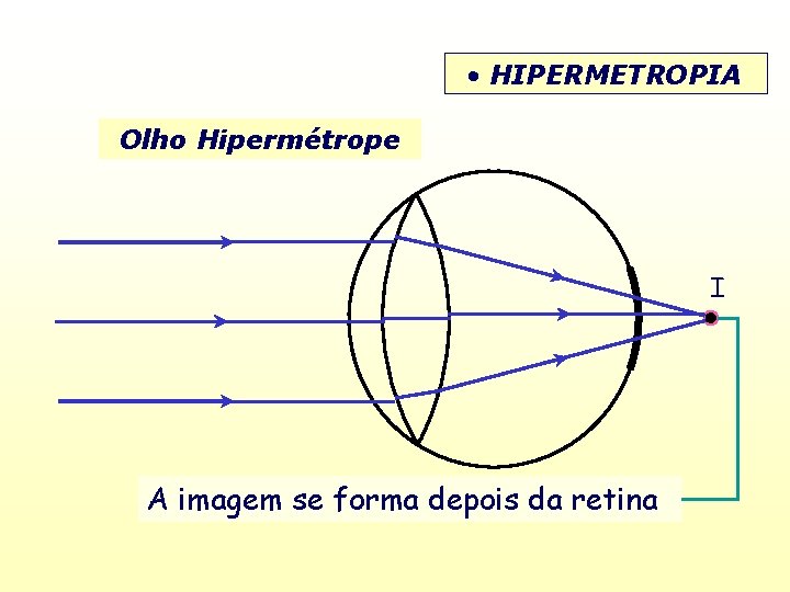  • HIPERMETROPIA Olho Hipermétrope I A imagem se forma depois da retina 