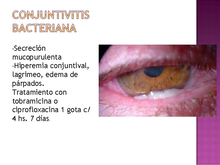 • Secreción mucopurulenta • Hiperemia conjuntival, lagrimeo, edema de párpados. Tratamiento con tobramicina • Secreción mucopurulenta • Hiperemia conjuntival, lagrimeo, edema de párpados. Tratamiento con tobramicina
