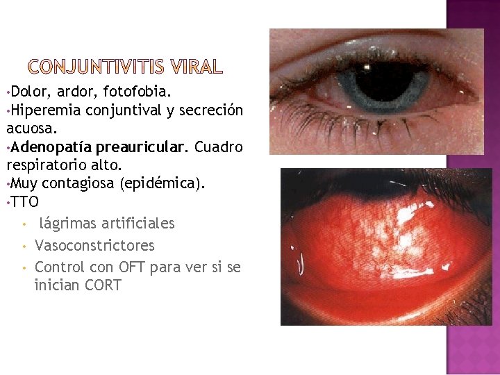 • Dolor, ardor, fotofobia. • Hiperemia conjuntival y secreción acuosa. • Adenopatía preauricular. • Dolor, ardor, fotofobia. • Hiperemia conjuntival y secreción acuosa. • Adenopatía preauricular.
