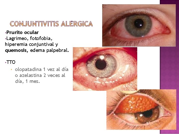 • Prurito ocular • Lagrimeo, fotofobia, hiperemia conjuntival y quemosis, edema palpebral. • • Prurito ocular • Lagrimeo, fotofobia, hiperemia conjuntival y quemosis, edema palpebral. •