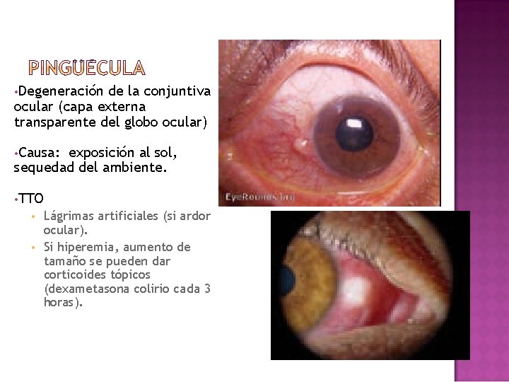 • Degeneración de la conjuntiva ocular (capa externa transparente del globo ocular) • • Degeneración de la conjuntiva ocular (capa externa transparente del globo ocular) •