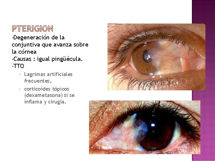 • Degeneración de la conjuntiva que avanza sobre la córnea • Causas : • Degeneración de la conjuntiva que avanza sobre la córnea • Causas :