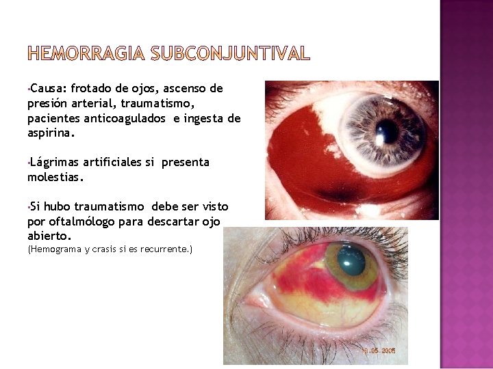 • Causa: frotado de ojos, ascenso de presión arterial, traumatismo, pacientes anticoagulados e • Causa: frotado de ojos, ascenso de presión arterial, traumatismo, pacientes anticoagulados e
