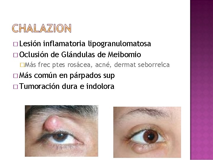 � Lesión inflamatoria lipogranulomatosa � Oclusión de Glándulas de Meibomio �Más � Más frec � Lesión inflamatoria lipogranulomatosa � Oclusión de Glándulas de Meibomio �Más � Más frec