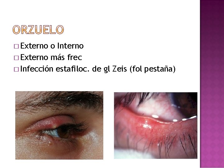 � Externo o Interno � Externo más frec � Infección estafiloc. de gl Zeis � Externo o Interno � Externo más frec � Infección estafiloc. de gl Zeis