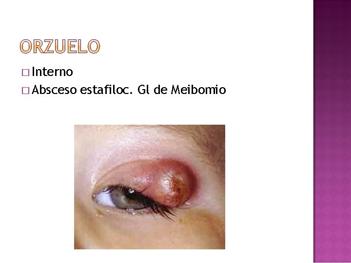 � Interno � Absceso estafiloc. Gl de Meibomio � Interno � Absceso estafiloc. Gl de Meibomio