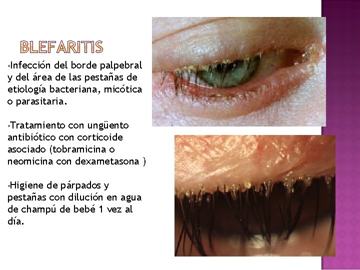 • Infección del borde palpebral y del área de las pestañas de etiología • Infección del borde palpebral y del área de las pestañas de etiología