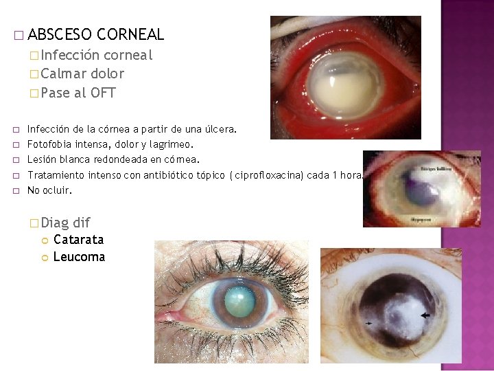 � ABSCESO CORNEAL � Infección corneal � Calmar dolor � Pase al OFT � � ABSCESO CORNEAL � Infección corneal � Calmar dolor � Pase al OFT �
