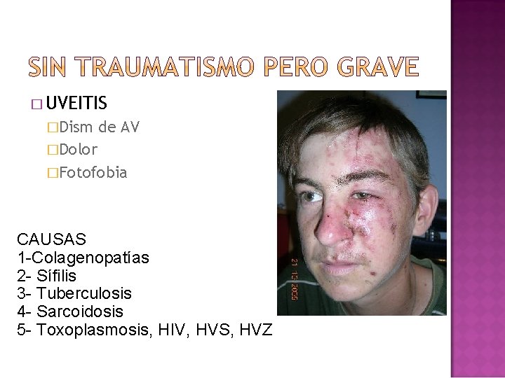 � UVEITIS �Dism de AV �Dolor �Fotofobia CAUSAS 1 -Colagenopatías 2 - Sífilis 3 � UVEITIS �Dism de AV �Dolor �Fotofobia CAUSAS 1 -Colagenopatías 2 - Sífilis 3
