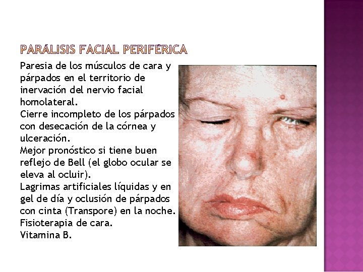 Paresia de los músculos de cara y párpados en el territorio de inervación del Paresia de los músculos de cara y párpados en el territorio de inervación del