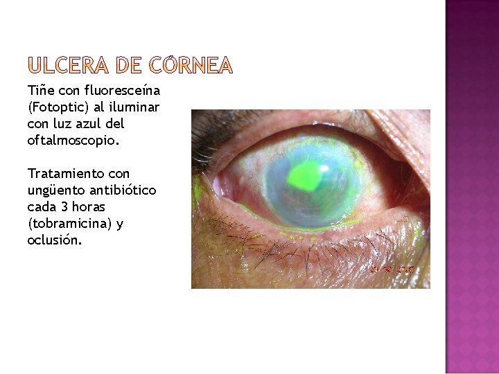Tiñe con fluoresceína (Fotoptic) al iluminar con luz azul del oftalmoscopio. Tratamiento con ungüento Tiñe con fluoresceína (Fotoptic) al iluminar con luz azul del oftalmoscopio. Tratamiento con ungüento