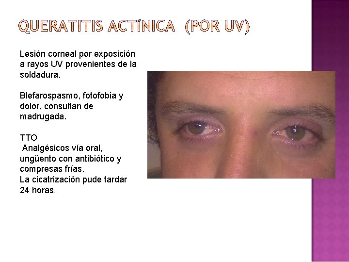 Lesión corneal por exposición a rayos UV provenientes de la soldadura. Blefarospasmo, fotofobia y Lesión corneal por exposición a rayos UV provenientes de la soldadura. Blefarospasmo, fotofobia y