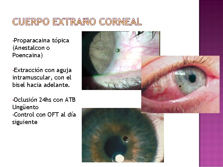 • Proparacaina tópica (Anestalcon o Poencaina) • Extracción con aguja intramuscular, con el • Proparacaina tópica (Anestalcon o Poencaina) • Extracción con aguja intramuscular, con el