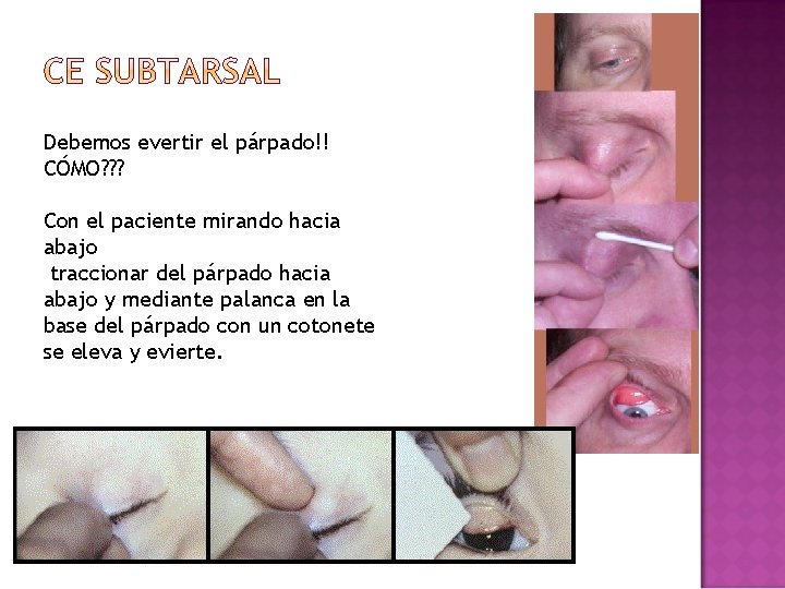 Debemos evertir el párpado!! CÓMO? ? ? Con el paciente mirando hacia abajo traccionar Debemos evertir el párpado!! CÓMO? ? ? Con el paciente mirando hacia abajo traccionar