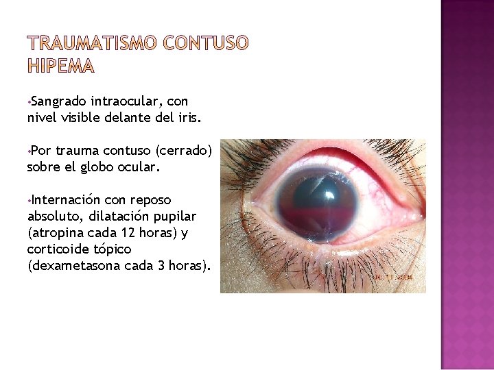 • Sangrado intraocular, con nivel visible delante del iris. • Por trauma contuso • Sangrado intraocular, con nivel visible delante del iris. • Por trauma contuso