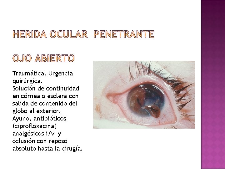 Traumática. Urgencia quirúrgica. Solución de continuidad en córnea o esclera con salida de contenido Traumática. Urgencia quirúrgica. Solución de continuidad en córnea o esclera con salida de contenido