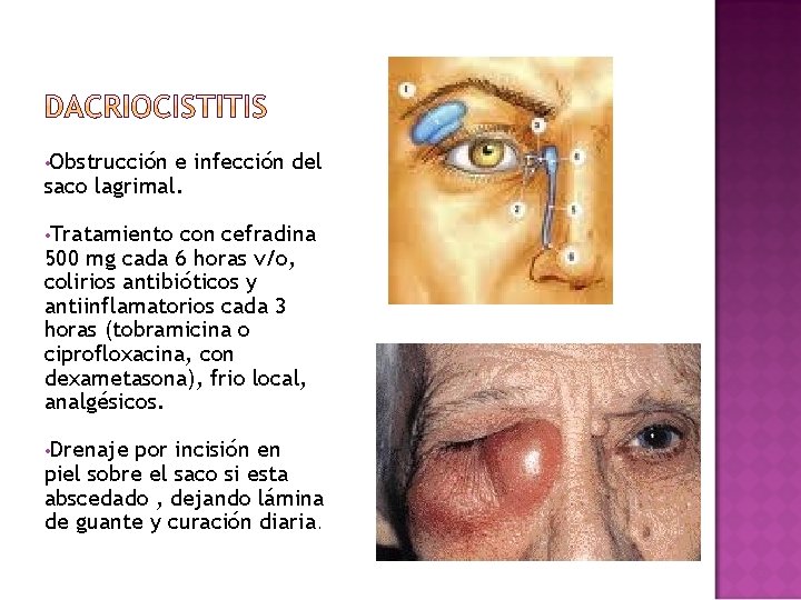 • Obstrucción e infección del saco lagrimal. • Tratamiento con cefradina 500 mg • Obstrucción e infección del saco lagrimal. • Tratamiento con cefradina 500 mg
