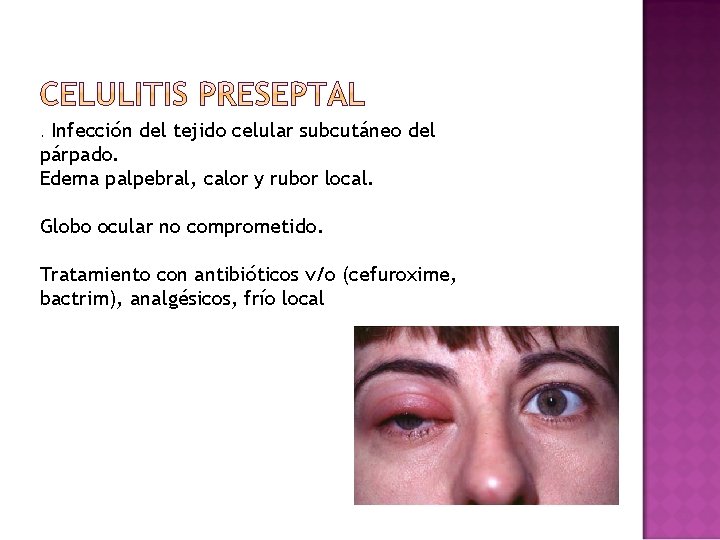 Infección del tejido celular subcutáneo del párpado. Edema palpebral, calor y rubor local. . Infección del tejido celular subcutáneo del párpado. Edema palpebral, calor y rubor local. .