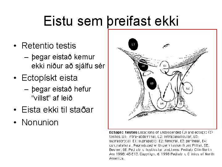 Eistu sem þreifast ekki • Retentio testis – þegar eistað kemur ekki niður að Eistu sem þreifast ekki • Retentio testis – þegar eistað kemur ekki niður að