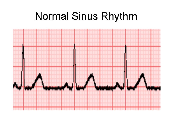 Normal Sinus Rhythm 