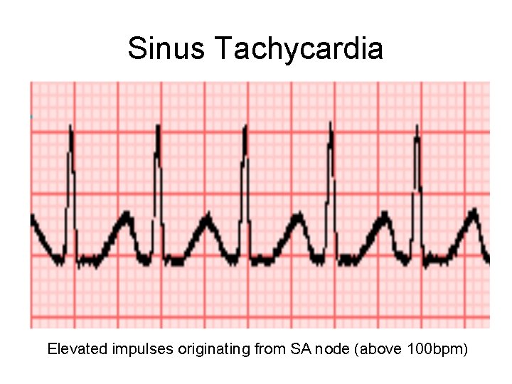 Sinus Tachycardia Elevated impulses originating from SA node (above 100 bpm) 