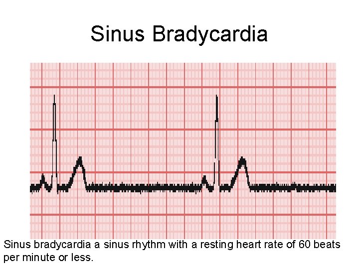 Sinus Bradycardia Sinus bradycardia a sinus rhythm with a resting heart rate of 60