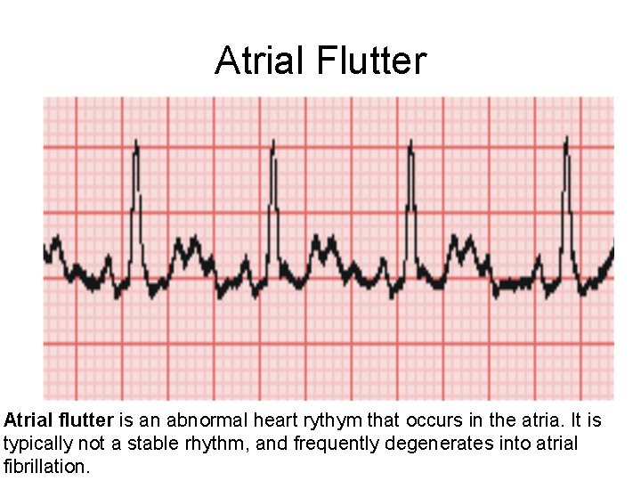 Atrial Flutter Atrial flutter is an abnormal heart rythym that occurs in the atria.