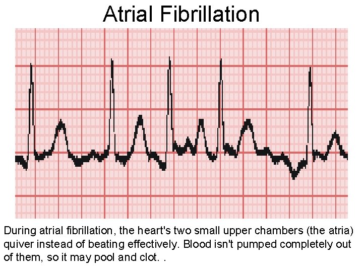 Atrial Fibrillation During atrial fibrillation, the heart's two small upper chambers (the atria) quiver