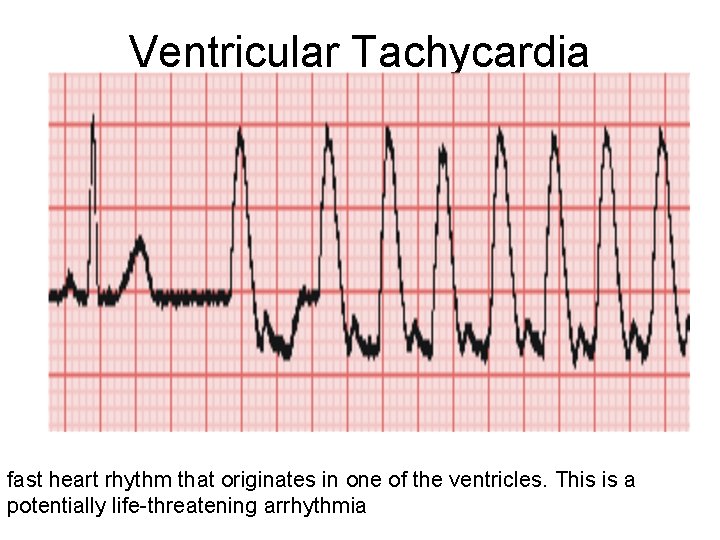 Ventricular Tachycardia fast heart rhythm that originates in one of the ventricles. This is