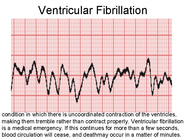 Ventricular Fibrillation condition in which there is uncoordinated contraction of the ventricles, making them