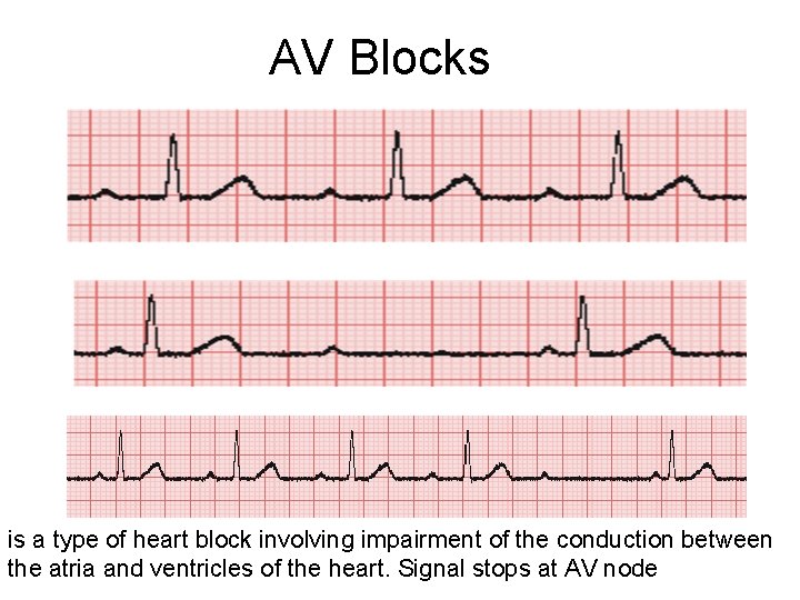 AV Blocks is a type of heart block involving impairment of the conduction between