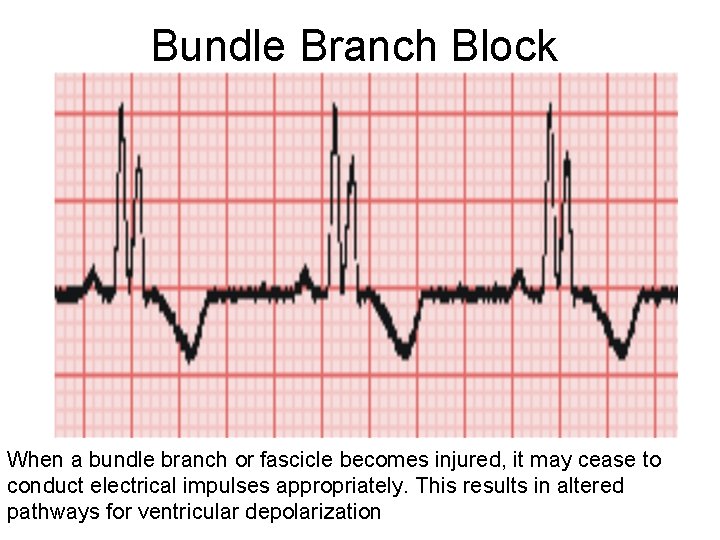 Bundle Branch Block When a bundle branch or fascicle becomes injured, it may cease