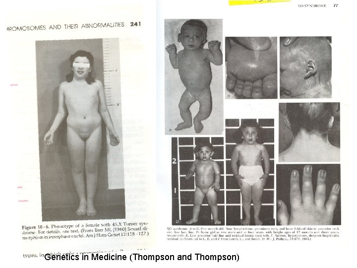  • Şekil 9 Genetics in Medicine (Thompson and Thompson) 