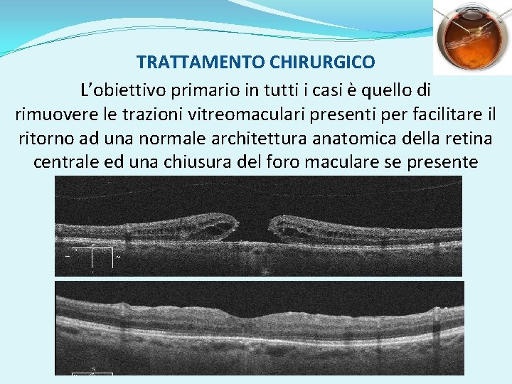 TRATTAMENTO CHIRURGICO L’obiettivo primario in tutti i casi è quello di rimuovere le trazioni