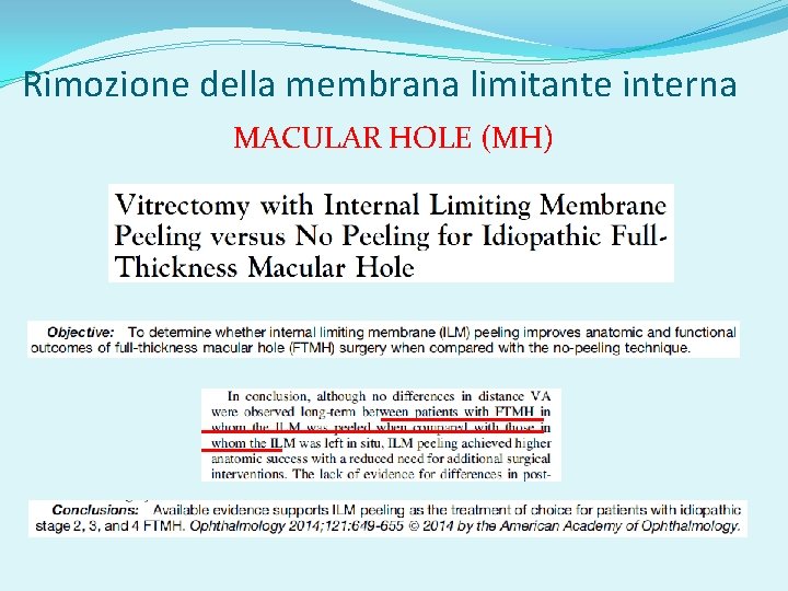 Rimozione della membrana limitante interna MACULAR HOLE (MH) 