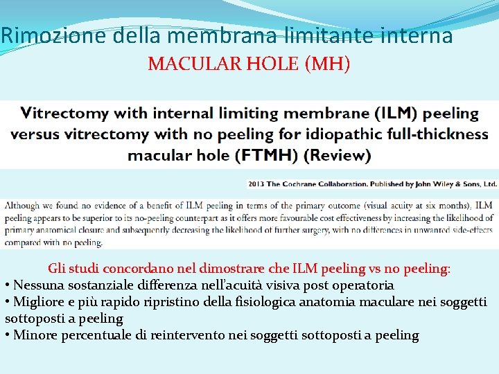 Rimozione della membrana limitante interna MACULAR HOLE (MH) Gli studi concordano nel dimostrare che