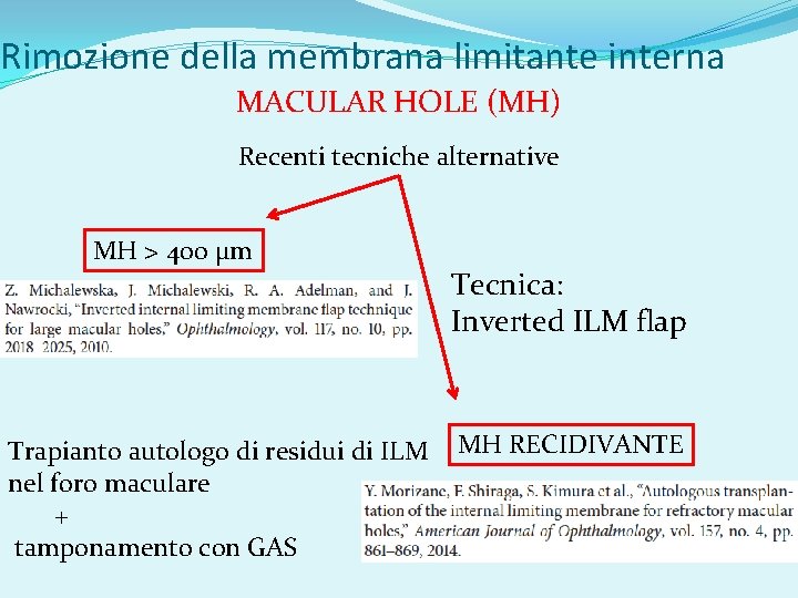 Rimozione della membrana limitante interna MACULAR HOLE (MH) Recenti tecniche alternative MH > 400