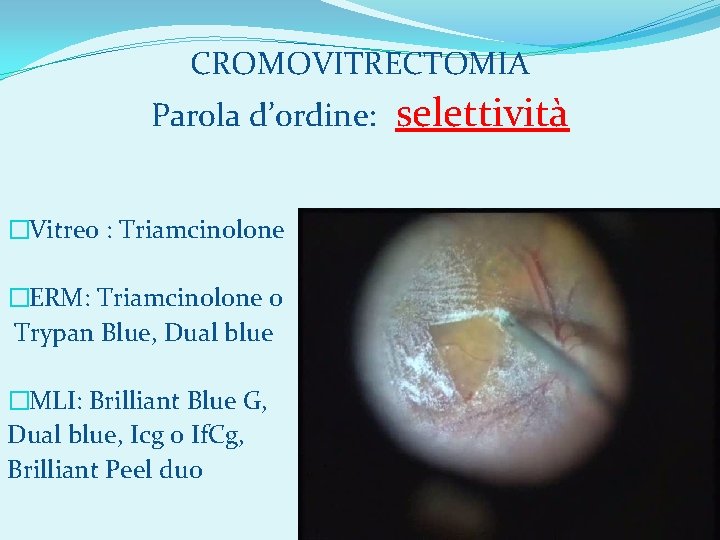 CROMOVITRECTOMIA Parola d’ordine: �Vitreo : Triamcinolone �ERM: Triamcinolone o Trypan Blue, Dual blue �MLI: