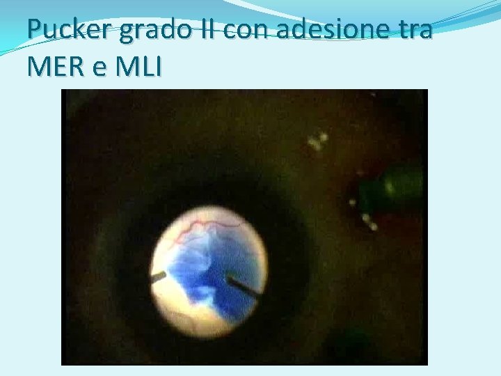 Pucker grado II con adesione tra MER e MLI 