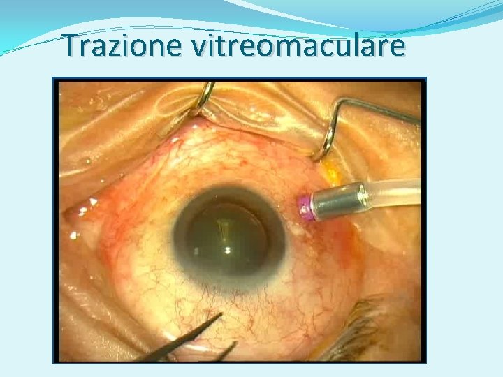 Trazione vitreomaculare 