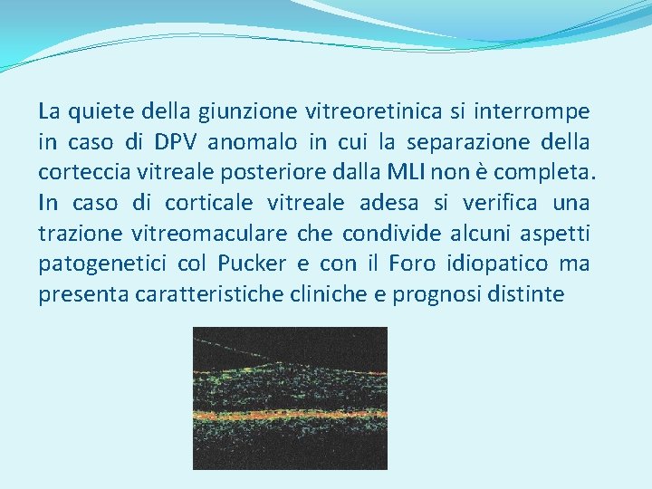 La quiete della giunzione vitreoretinica si interrompe in caso di DPV anomalo in cui