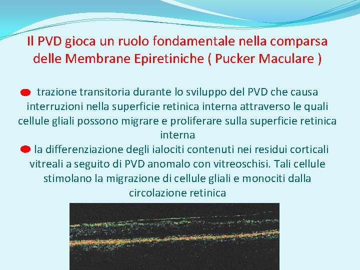 Il PVD gioca un ruolo fondamentale nella comparsa delle Membrane Epiretiniche ( Pucker Maculare