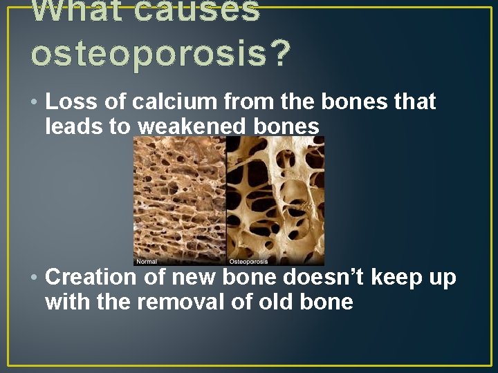 What causes osteoporosis? • Loss of calcium from the bones that leads to weakened