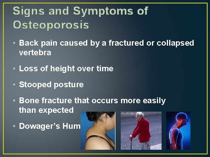 Signs and Symptoms of Osteoporosis • Back pain caused by a fractured or collapsed