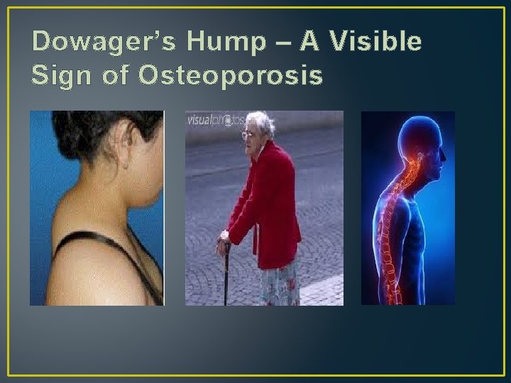 Dowager’s Hump – A Visible Sign of Osteoporosis 