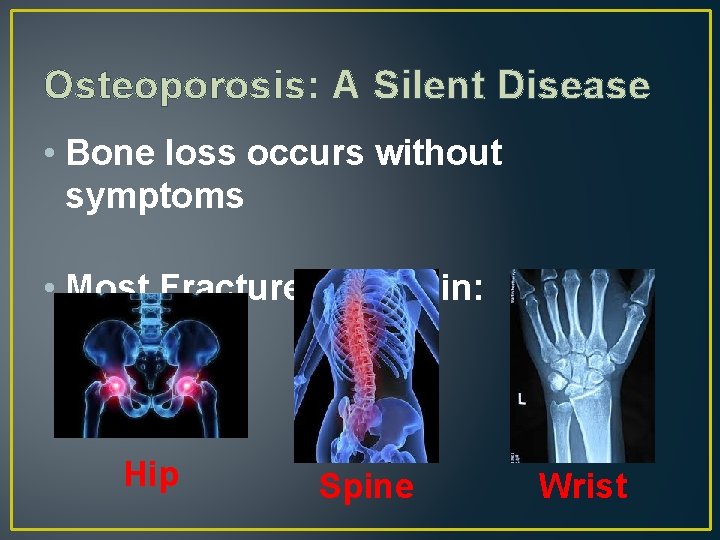 arthrosis osteoporosis a vállízület