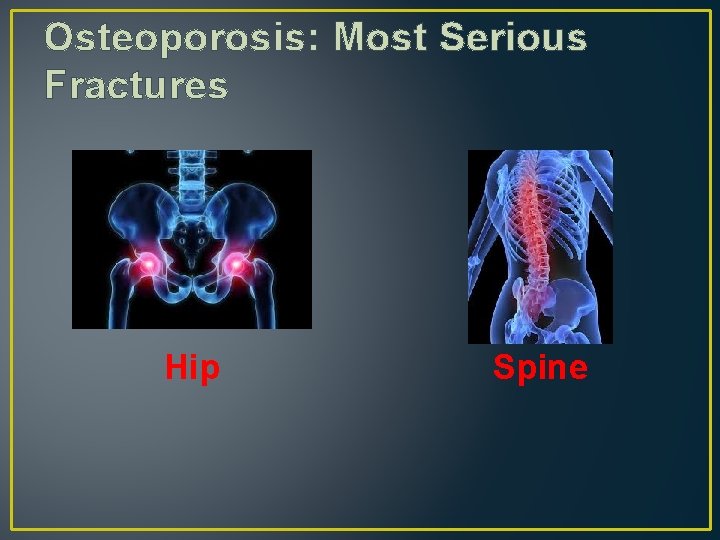 Osteoporosis: Most Serious Fractures Hip Spine 