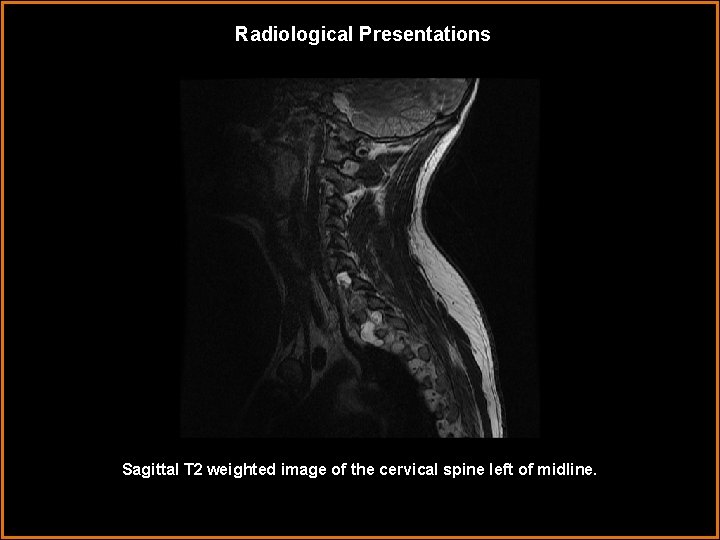 Radiological Presentations Sagittal T 2 weighted image of the cervical spine left of midline.