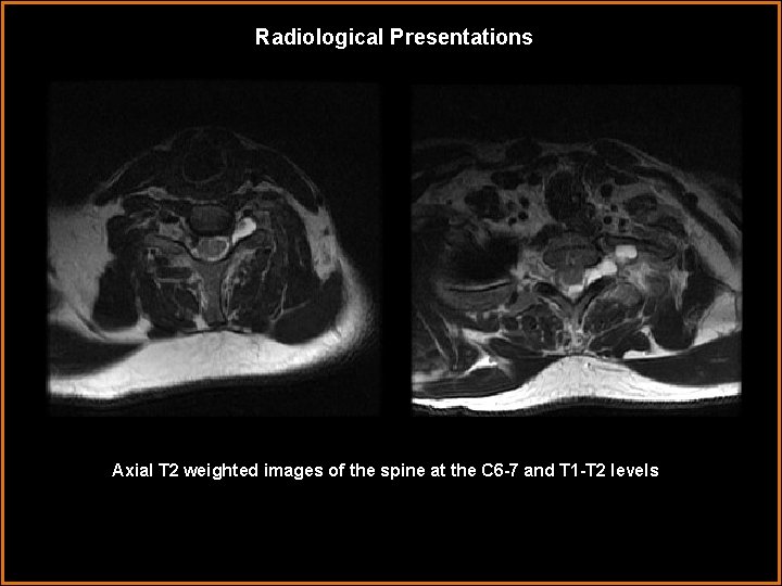 Radiological Presentations Axial T 2 weighted images of the spine at the C 6