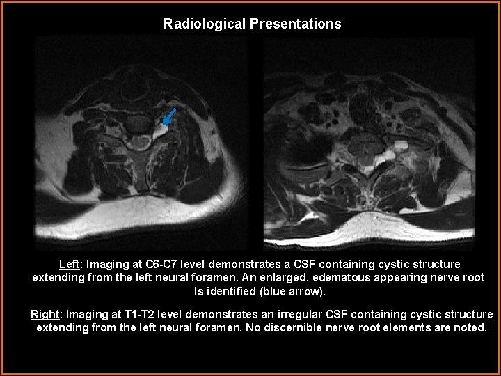 Radiological Presentations Left: Imaging at C 6 -C 7 level demonstrates a CSF containing
